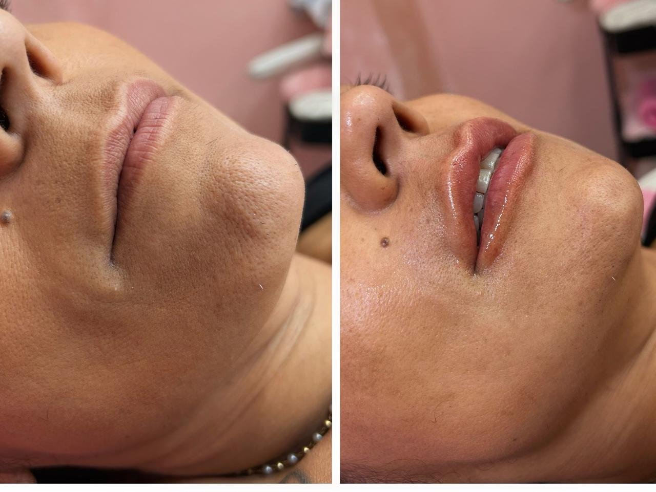 Imagem relacionada a preenchimento labial